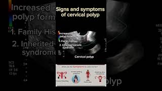 Signs amp Symptoms of Cervical Polyps healthytips shortsbeta ultrasound ytshort DrSaimakhan [upl. by Esina]