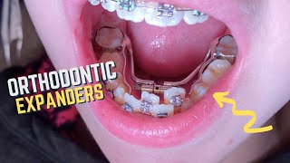 Braces Checkups  11 year old patient  Upper and Lower Orthodontic Expanders  Tooth Time [upl. by Yllut910]