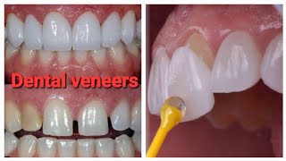 Dental VeneersTeeth VeneersCosmatic Dentistry [upl. by Harman]