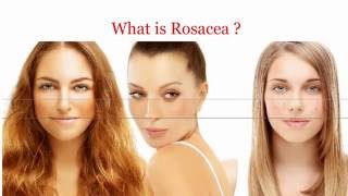 What is Rosacea [upl. by Sullecram585]