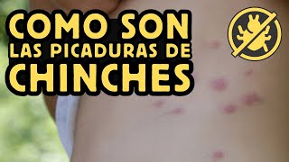 Como son las PICADURAS de las CHINCHES de CAMA [upl. by Ellenig]