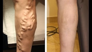 After Watching THIS Youll Learn How To Get Rid of Varicose Veins Naturally [upl. by Remark]