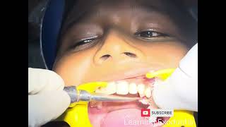 Retained Deciduous Extraction dentist dentistry trending youtube oralsurgery [upl. by Baecher813]