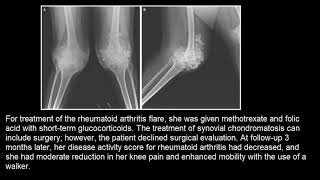 Synoviale Chondromatose [upl. by Silenay]