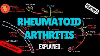 RHEUMATOID ARTHRITIS Pathogenesis EULAR Guidline diagnostic criterias Xray Treatment [upl. by Lidda]