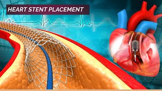 Angioplasty for Narrowing Heart Arteries  Heart Stent Placement  Stent 3D Animation [upl. by Doehne]