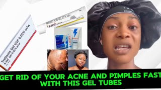 HOW TO GET RID OF SEVERE ACNE✨PIMPLES✨WHITEHEADS✨BLACKHEADSGEL TUBES CREAM FOR ACNE PRONE SKIN [upl. by Anatollo]