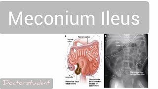 Meconium Ileus [upl. by Asyle]