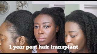 1 Year after my Hair Transplant Before and After [upl. by Vonni]