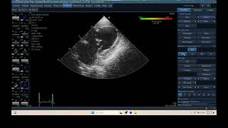 IQ 306 TSI TISSUE SYNCHRONY IMAGING ECHOPAC ANALYSIS ECHOCARDIOGRAPHY HEPATOMA PTE [upl. by Kcyrred]