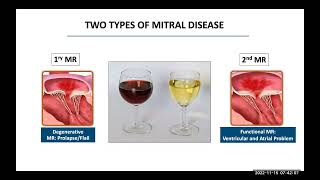 Update in Transcatheter Mitral Valve Interventions [upl. by Aoht]