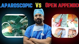 Laparoscopic vs open appendectomy l educationalvideo appendicitis surgeons jamui yt trending [upl. by Timotheus]