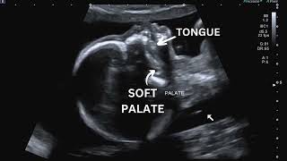 Ultrasound Pregnancy Palate hard and soft palate for cleft palate and cleft lips assessment [upl. by Cower938]