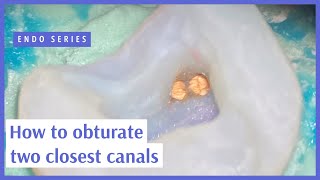 How to obturate two closest canals [upl. by Glanville]