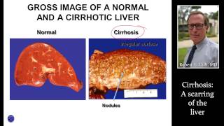 CIRRHOSIS LIVER SCARRING by Dr Robert Gish [upl. by Dumas]