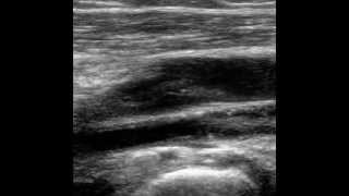 POPLITEAL VEIN FLOATING THROMBUS [upl. by Aihsem]