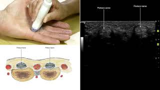 anisotropi fingerflexor sener [upl. by Orest286]