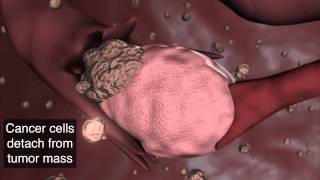 Ovarian Cancer Metastasis [upl. by Yhtommit]