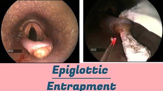 Epiglottic Entrapment [upl. by Aekal]