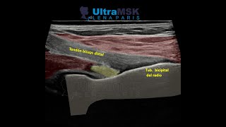 ¿Como evaluar la porción distal del bíceps en ultrasonido [upl. by Airehs870]