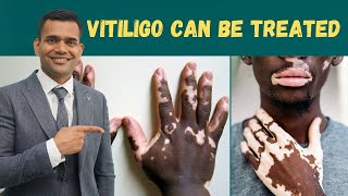 Vitiligo Leucoderma  Can Be Treated  Herbs And Vitamins To Treat Vitiligo  Dr Vivek Joshi [upl. by Zalea]