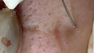 Loan Nguyen Acne Treatment 1645mh [upl. by Fabyola76]