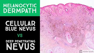 Melanocytic Dermpath Cellular Blue Nevus vs Deep Penetrating NevusMelanocytoma [upl. by Danell]