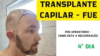 TRANSPLANTE CAPILAR  TÉCNICA FUE 4° DIA PÓS OPERATÓRIO [upl. by Willow236]