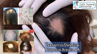 โรคผมร่วงเป็นหย่อม Alopecia areata AA มีลักษณะอย่างไร รักษาอย่างไร หมอรุจชวนคุย รักษาผมร่วง [upl. by Groome]