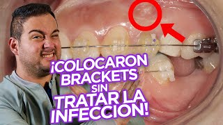 ¡BRACKETS Ortodoncia con DIENTES con ENDODONCIA TRATAMIENTOS DE CONDUCTO ¿SE PUEDE ¡CASO REAL [upl. by Dedrick]