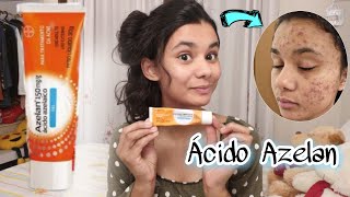 MINHA EXPERIÊNCIA com ÁCIDO AZELAICO AzelanVanessa Marçal [upl. by Jolynn]