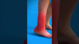 sprained ankle explained viral knowledgetak [upl. by Saxe]