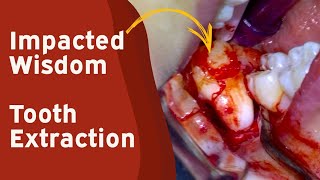 107 Live Impacted Wisdom Tooth Extraction Surgery [upl. by Rettke824]