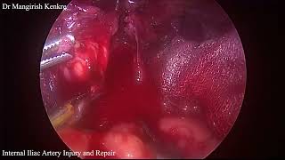 Internal Iliac Artery Injury [upl. by Everest]