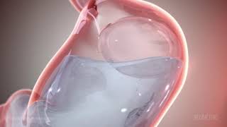 Gastric Balloon medical animation by Geometric Medical [upl. by Yecram]