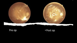 vitrectomy in vitreous haemorrhage with focal traction [upl. by Eradis175]