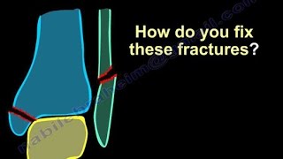 Ankle Fractures Surgical Treatment tactics  Everything You Need To Know  Dr Nabil Ebraheim [upl. by Magdau]