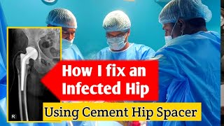 How do i fix an infected hip doctor hipsurgery hospital [upl. by Alyworth553]