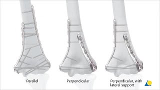 USMLERx Express Video of the Week Common Pediatric Fractures [upl. by Tennaj]