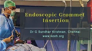 Endoscopic Grommet Insertion  Dr G Sundhar Krishnan Chennai [upl. by Auqinihs439]