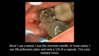 Intra Osseous with Extraction with Dr Lincoln Harris [upl. by Ainoda]