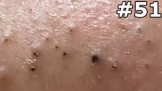 quot🔴 Satisfying Pimple Popping Extravaganza Watch the Most Satisfying Pops Everquot 51 [upl. by Akcimahs137]