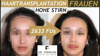 FUE Haartransplantation Frauen  Hohe Stirn amp Geheimratsecken  Vorher Nachher  Haarlinie abgesenkt [upl. by Stig548]