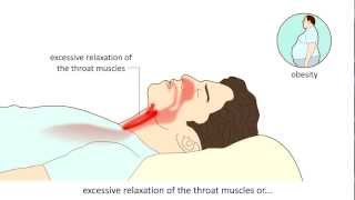 Obstructive Sleep Apnea Syndrome OSAS  Causes and treatment [upl. by Quennie]