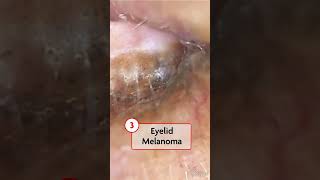 NEJM Images in Clinical Medicine Rare Melanomas [upl. by Farand]