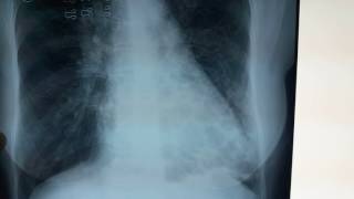 Bronchiectasis Chest Xray  What is bronchiectasis [upl. by Zach]