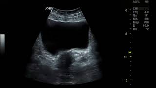 Bicornuate uterus pregnancy [upl. by Pinter]