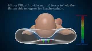 Plagiocephaly amp Brachycephaly Prevention with Mimos Pillow [upl. by Dode]