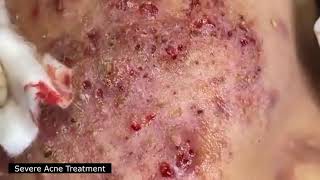 BEST BLACKHEAD AND WHITEHEAD REMOVAL SEVERE ACNE TREATMENT  SATISFYING AND RELAXING VIDEO [upl. by Ardnuahsal]