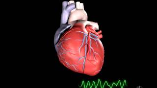 What is Ventricular Fibrillation [upl. by Johann]